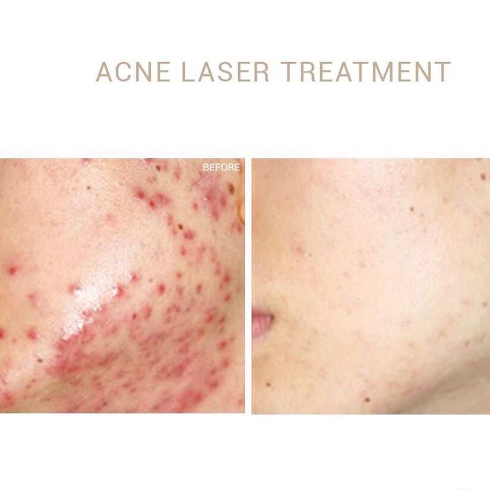 Skin Care Laser and Acne Treatment